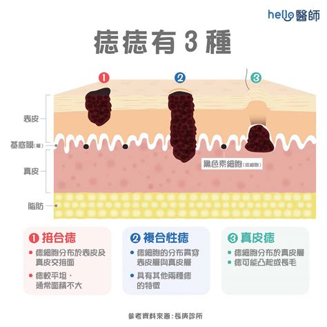 突出來的痣|痣是什麼？一次了解痣原因、就醫時機以及如何改善